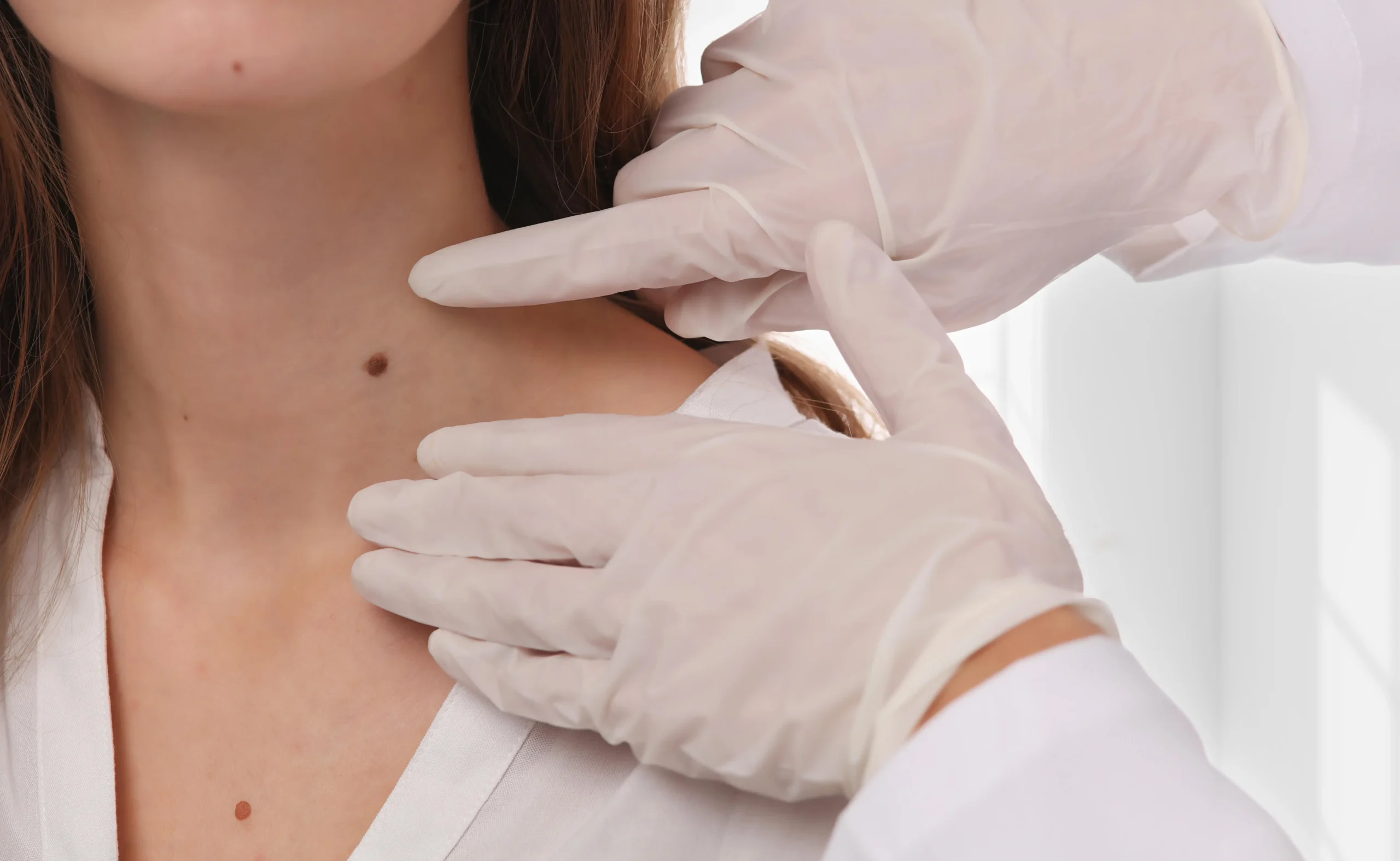 Skin Tag Removal in New York, NY by Refined Glow
